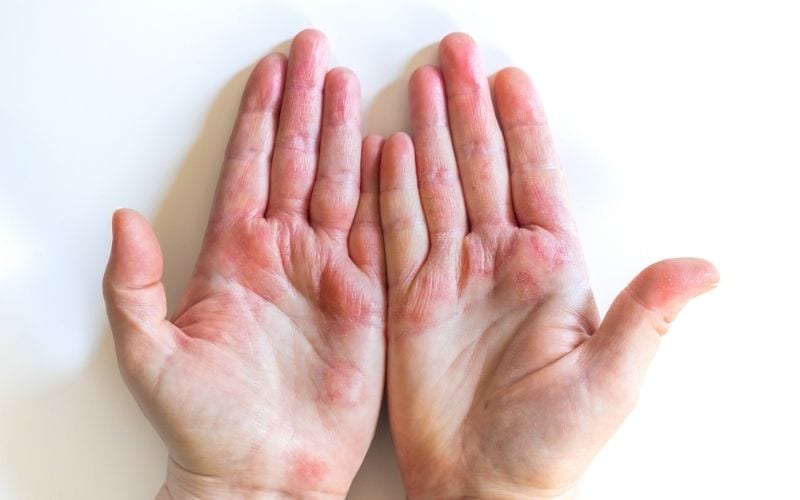Photo of 2 hands with reddening of skin